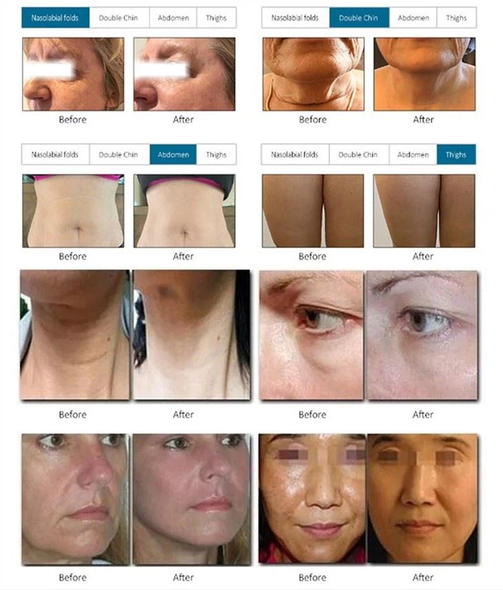 Hifu For Face