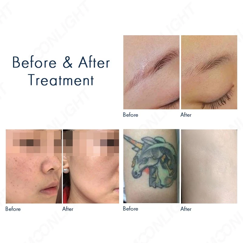 2 in 1 ND YAG + Diode Laser Machine | Professional Multi-Functional Aesthetic Laser System high quality