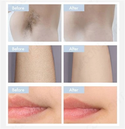 Commercial Laser Hair Removal Machine