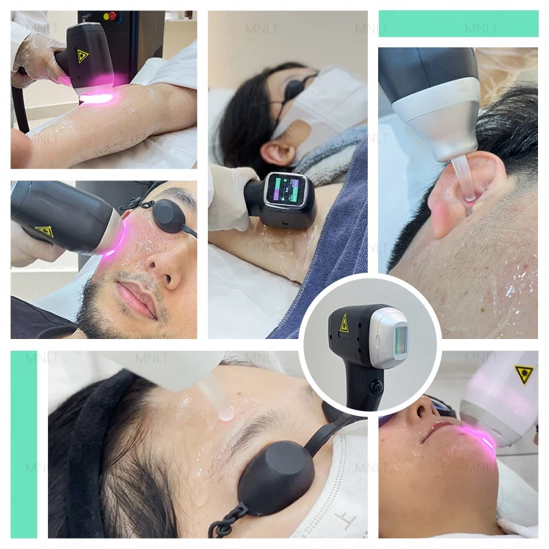 Laser For Hair Removal Machine